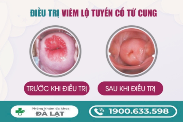 Cách Chữa Viêm Lộ Tuyến Cổ Tử Cung 